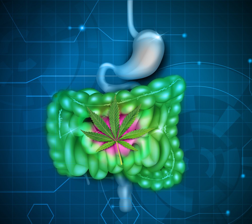 Tratamiento con cannabis medicinal para el síndrome del intestino irritable (SII)